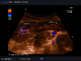 Ultrazvok ledvic - prirojena anomalija ledvic podkvasta ledvica ledvici sta povezani
